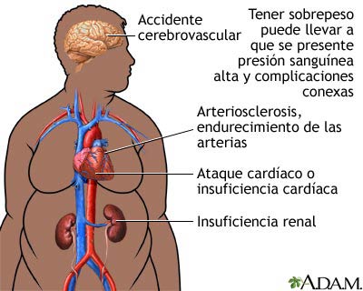 Infografía sobre obesidad