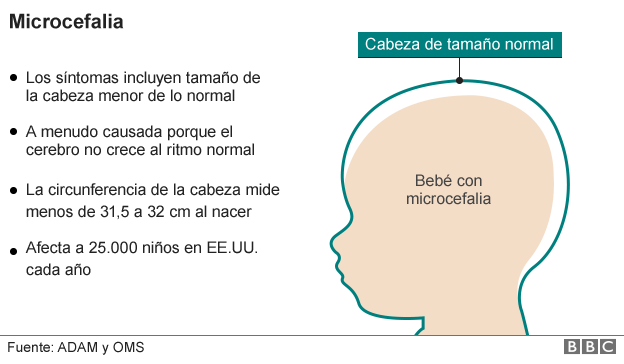 Efectos de la microcefalia.