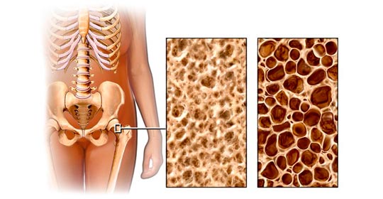 ¿Qué es y cómo se trata la osteoporosis?