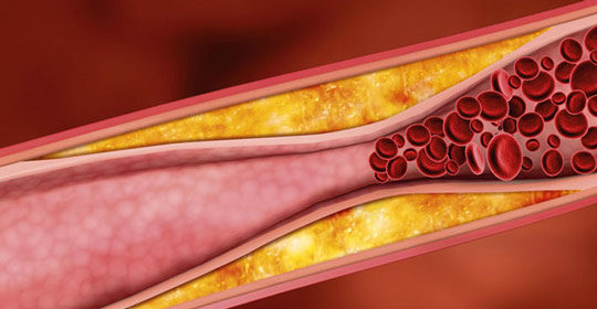 ¿Provoca infartos el colesterol?